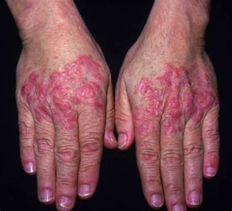 Lupus - Systemic Lupus Erythematosus (SLE) - Causes, Sign & Symptoms