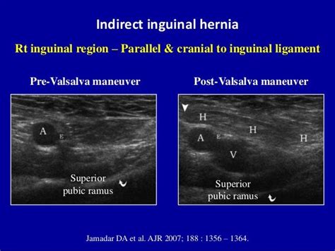 Valsalva Hernia Inguinal - Noticias Formosago