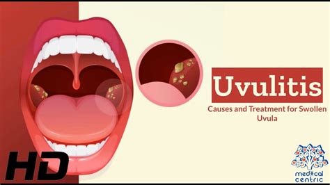 Uvulitis Explained: What's Causing Your Swollen Uvula?, 47% OFF