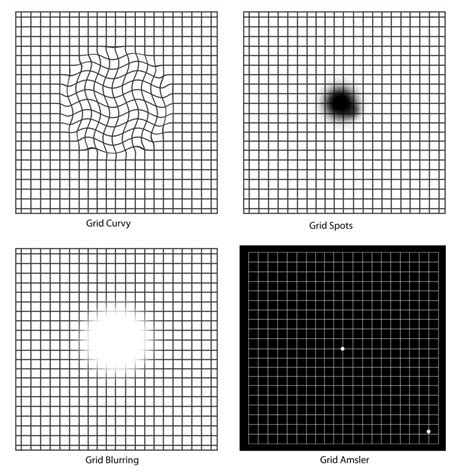 Macular Degeneration Grid: Check Your Vision with an Amsler Grid