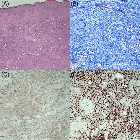 Histology and immunohistology of diffuse large B‐cell lymphoma. A ...