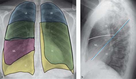 Lung and Pleura | Radiology Key