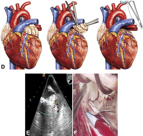 Left Atrial Appendage Occlusion: Lessons Learned From Surgical and ...