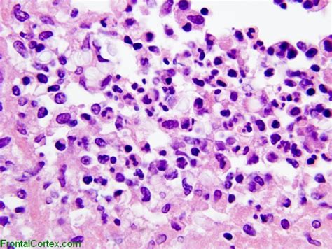 Cryptococcal meningitis, high-power H&E stained section.