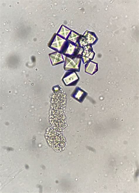 Calcium Oxalate Dihydrate Crystals In Urine