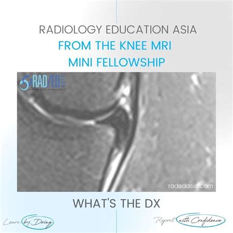 MENISCUS FLAP TEAR MRI KNEE - Radedasia