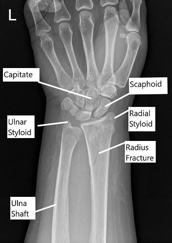 Distal radius fracture - pospoliz