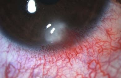 External eye disease and the oculocutaneous disorders | Ento Key