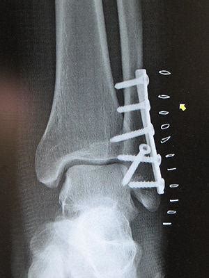 Fibula fracture surgery | General center | SteadyHealth.com