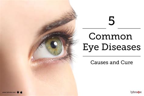 5 Most Common Eye Diseases: Causes and Cure - By Bharti Eye Hospitals ...