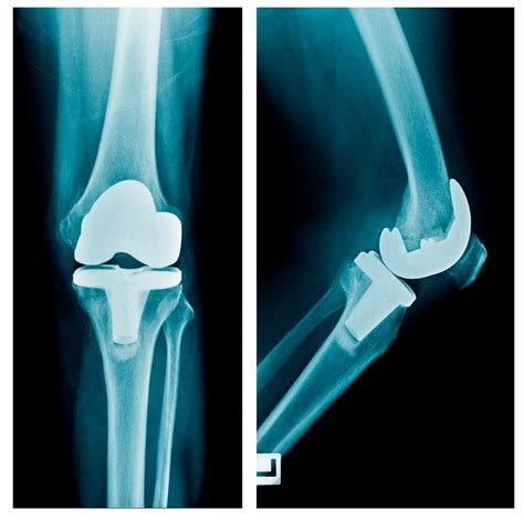 Total Knee Replacement (TKR) | Dr A. Theodorides Knee Surgeon Specialist