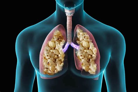 Popcorn Lung and Vaping. Symptoms and Signs