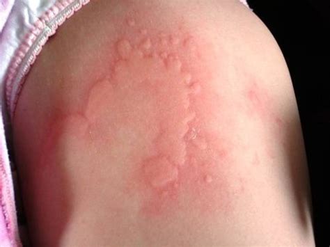 Treatment Of Common Allergic Reactions – PM Press