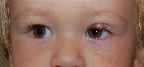 Eye Diseases: 10 Common Eye Diseases