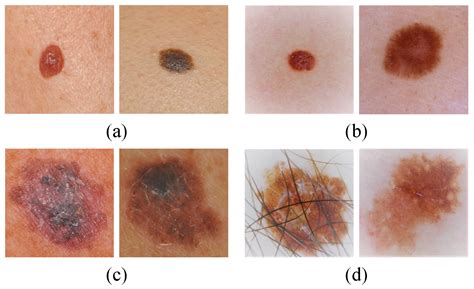 Melanoma images early stages, melanoma pictures early stages, early ...