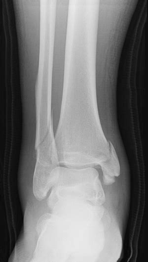 Broken Ankle: Types of Fractures, Diagnosis & Treatments | HSS