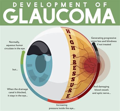 Infographic with Development of Untreated Glaucoma Disease - Discovery ...