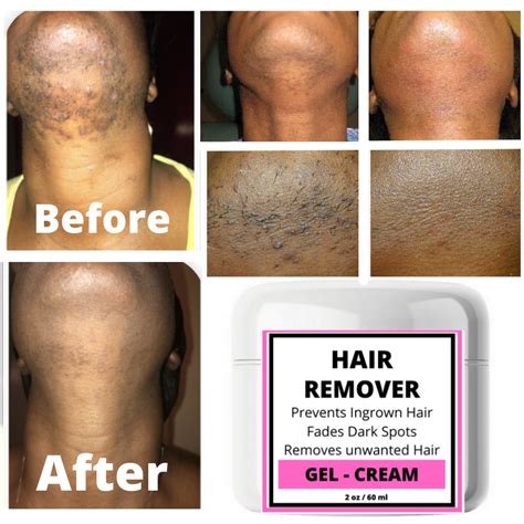 Ingrown Hair Removal