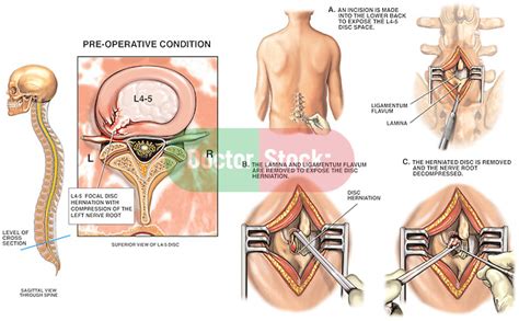 L4-5 Disc Herniation with Laminotomy and Proposed Discectomy | Doctor Stock