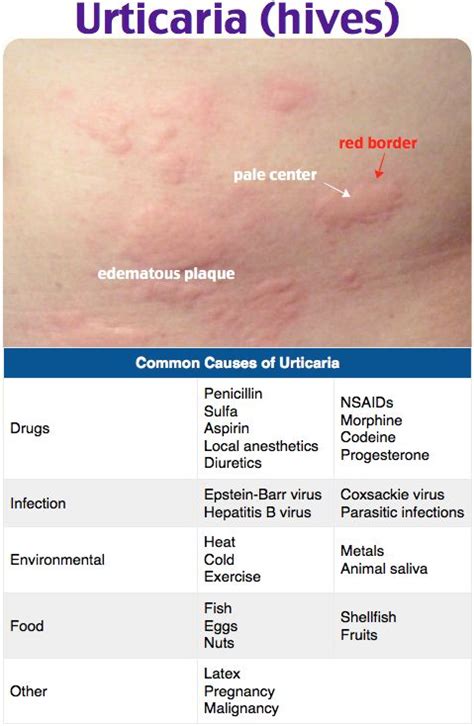 Hives Mild ~ Heat Rash Symptoms - What are the Signs of Heat Rashes ...