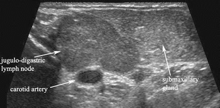 Jugulodigastric Lymph Node Level - Slide 1 / The jugulodigastric (jd ...