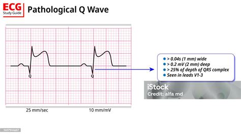 Pathological Q Wave