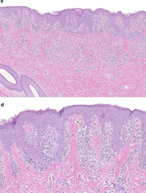 Acquired Melanocytic Nevus | Basicmedical Key