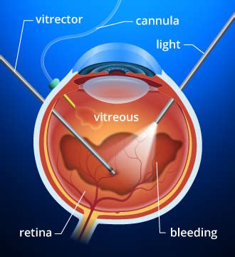 Diabetic retinopathy treatment options | All About Vision