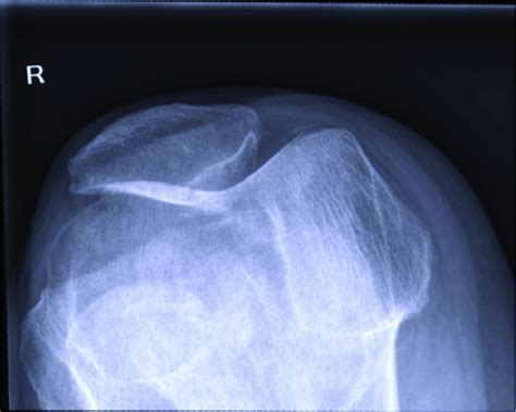 Sunrise X-Ray of the affected knee. | Download Scientific Diagram