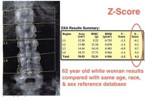 Bone Density Scan Results / DXA Tests: What you must know / The most ...