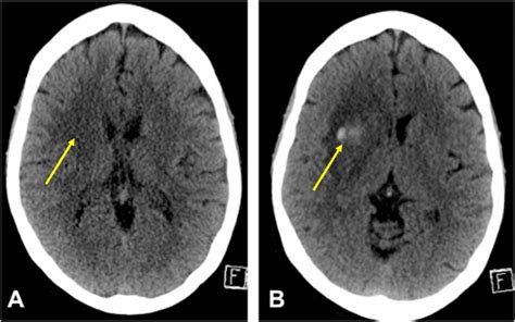 Hemorrhagic transformation of cerebral infarct – Radiology Cases