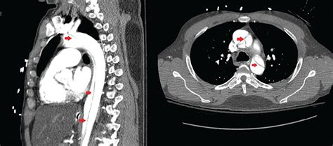 Aortic dissection presenting as ischemic limb | Cleveland Clinic ...