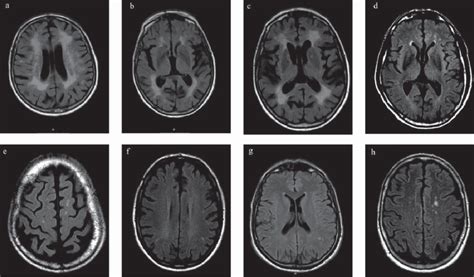 Brain magnetic resonance imaging (MRI) with axial Fluid Attenuated ...