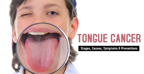 White Bump On Tongue Cancer