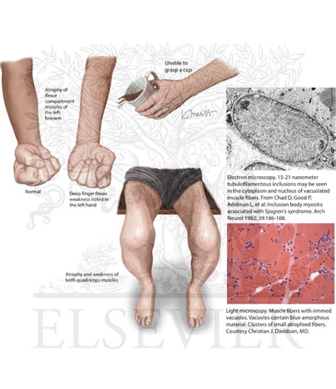 Inclusion Body Myositis