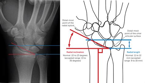 Ulna Bone Fracture