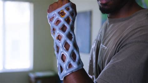 A 3D Printed Waterproof & Breathable Arm Cast