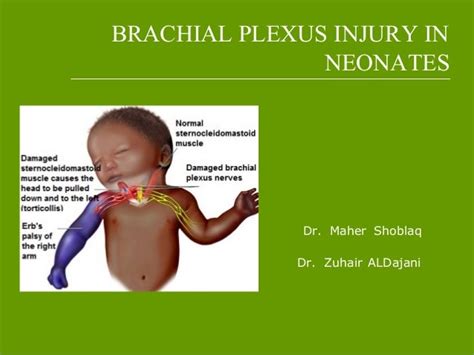 Brachial plexus