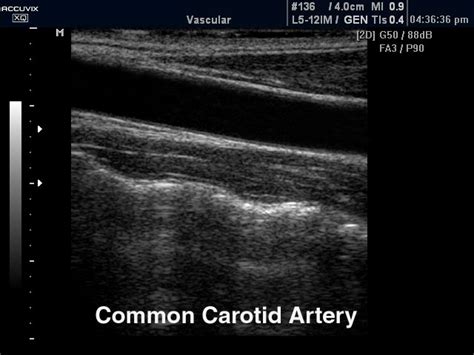 Ultrasound images • Common carotid artery, B-mode, echogramm №327