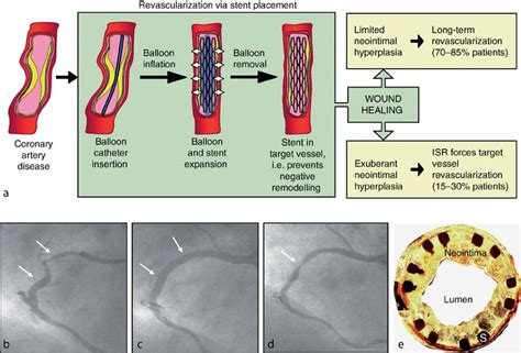 Stent Restenosis | SpringerLink