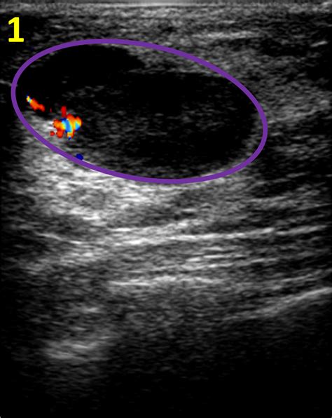 Cureus | Malignant Phyllodes Tumor of the Breast in a 26-year-old Woman