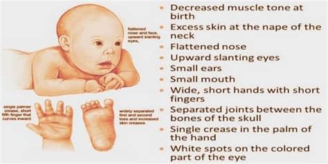 Down Syndrome (Symptoms, Diagnosis, and Treatment) - Assignment Point