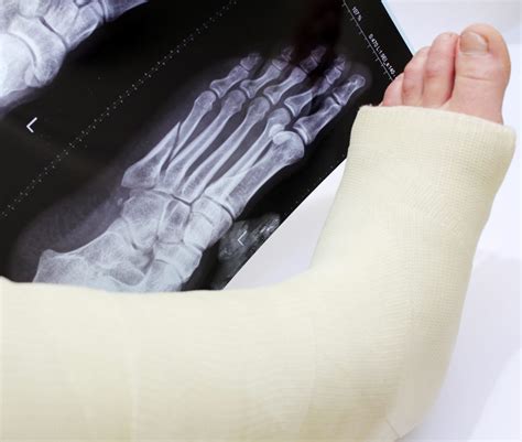 Foot and Ankle Fractures - Southern California Foot & Ankle Specialists