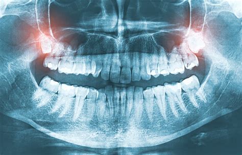 Panoramic X-Rays & CT Scans | Polk City, FL | Welcome to Kreative Dental