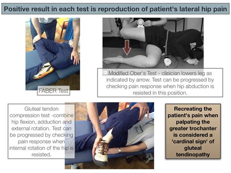 Gluteal Tendinopathy - RunningPhysio