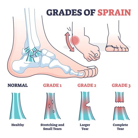 Grades Of Sprain As Ankle Or Foot Medical Injury Levels Outline - NTFANTFA