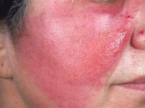 Cellulitis causes, signs, symptoms, diagnosis, prevention and treatment