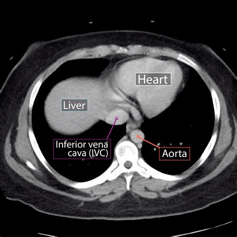 Gross Anatomy Glossary: Axial Abdominal CT | Draw It to Know It