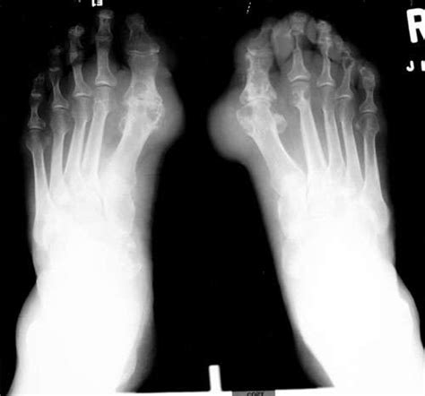 Radiological Charcot Arthropathy | Arthritis Research and Glucosamine ...