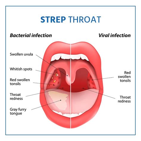 Strep Throat Symptoms, Causes and Treatment